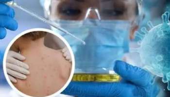 Monkeypox Suspected In Kerala: സംസ്ഥാനത്ത് മങ്കി പോക്സെന്ന് സംശയം? യുഎഇയിൽ നിന്നും വന്ന ആൾ നിരീക്ഷണത്തിൽ!