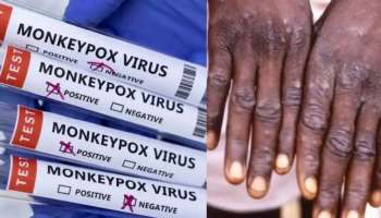 Monkeypox Kerala: മങ്കിപോക്സ് സ്ഥിരീകരിച്ച രോ​ഗി സഞ്ചരിച്ച ഓട്ടോറിക്ഷകളിലെ ഡ്രൈവർമാരെ കണ്ടെത്തി നിരീക്ഷണത്തിലാക്കി