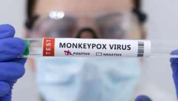 Monkey Pox Updates: മങ്കിപോക്സ് ലക്ഷണങ്ങളുമായി കണ്ണൂർ സ്വദേശി,സ്രവം വിദഗ്ധ പരിശോധനയ്ക്ക്