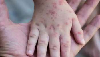 Monkeypox New Case: സംസ്ഥാനത്ത് ഒരാൾക്ക് കൂടി മങ്കിപോക്‌സ് സ്ഥിരീകരിച്ചു: മന്ത്രി വീണാ ജോര്‍ജ്