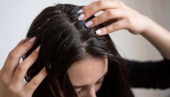 Dandruff Remedies : താരൻ മൂലമുള്ള മുടി കൊഴിച്ചിലും ചൊറിച്ചിലും ഉണ്ടോ? കാരണം, പ്രതിവിധി, തുടങ്ങി അറിയേണ്ടതെല്ലാം 