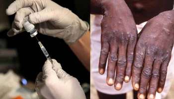 Monkeypox Update: ഛത്തീസ്ഗഢിലും മങ്കിപോക്സ്? രണ്ടുപേര്‍ നിരീക്ഷണത്തില്‍ 