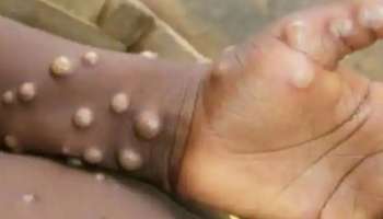 Monkeypox: ഇന്ത്യയിലെ മങ്കിപോക്സ് കേസുകൾ യൂറോപ്പിലെ കേസുകളിൽ നിന്ന് വ്യത്യസ്തമെന്ന് ഐസിഎംആർ