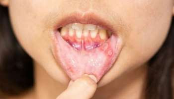 Mouth Ulcers: വായിലെ അൾസറിനെ പ്രതിരോധിക്കാൻ അ‍ഞ്ച് പ്രകൃതിദത്ത മാർ​ഗങ്ങൾ വീട്ടിൽ തന്നെ ചെയ്യാം