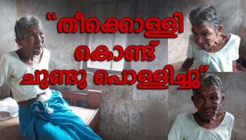 മകൾ തീക്കൊള്ളികൊണ്ട് പൊള്ളിച്ചു,ദേഷ്യം പിടിച്ചാൽ ദിവസവും മർദ്ദനം,72കാരി അമ്മയുടെ ദുരവസ്ഥ