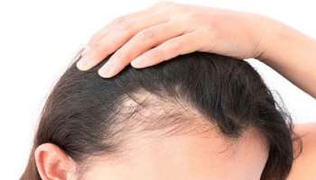 Hair Fall Ayurvedic Remedies: മുടി കൊഴിച്ചില്‍ ഇല്ലാതാകും, ഈ ആയുർവേദ നുറുങ്ങുകള്‍ പരീക്ഷിക്കൂ