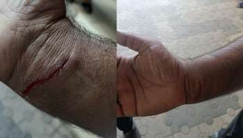 Dog attack: വാക്സിനേഷൻ എടുക്കുന്നതിനിടെ ലൈഫ് സ്റ്റോക് ഇൻസ്പെക്ടർക്ക് വളർത്ത് നായുടെ കടിയേറ്റു