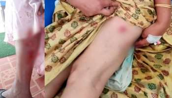 Stray dog attack: ഇടുക്കിയിൽ തെരുവുനായയുടെ ആക്രമണം; വയോധിക ഉൾപ്പടെ ഏഴ് പേർക്ക് കടിയേറ്റു