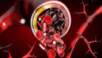 Sickle Cell Anemia: സിക്കിൾ സെൽ അനീമിയ കുട്ടികളെയും കൗമാരക്കാരെയും സ്ട്രോക്കിലേക്ക് നയിക്കുന്നുവെന്ന് സിഡിസി റിപ്പോർട്ട്