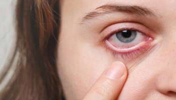 Dry Eye Syndrome: എന്തുകൊണ്ടാണ് കണ്ണുകളിൽ വരൾച്ച ഉണ്ടാകുന്നത്? കാരണങ്ങളും പരിഹാരവും അറിയാം 