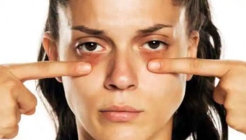 Dark Circles Remedy:  കണ്ണിന് താഴെയുള്ള കറുപ്പകറ്റാം! ഈ കാര്യങ്ങൾ ഒന്ന് ചെയ്ത് നോക്കൂ...
