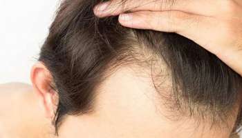 Hair Fall Tips: ഇത്രയും കാര്യങ്ങൾ വീട്ടിൽ ചെയ്താൽ മതി പുരുഷൻമാരുടെ മുടി കൊഴിച്ചിൽ പമ്പ കടക്കും