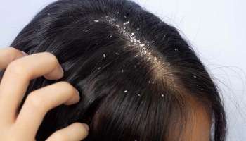 Dandruff Remedies : താരനെ ഇല്ലാതാക്കാന്‍ വീട്ടിൽ തന്നെ ചെയ്യാൻ കഴിയുന്ന ചില എളുപ്പ വിദ്യകൾ 