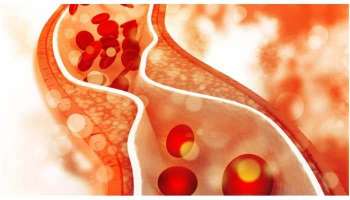 Cholesterol Symptoms: ശരീരത്തില്‍ കൊളസ്‌ട്രോളിന്‍റെ അളവ് കൂടിയോ? എങ്ങിനെ അറിയാം  