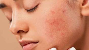 Acne: ആർത്തവ സമയത്ത് മുഖക്കുരു ഉണ്ടാകുന്നത് തടയാം; ഇക്കാര്യങ്ങൾ ചെയ്യൂ