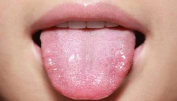 Tongue Color: നാവ് പറയും നിങ്ങളുടെ ആരോഗ്യം 