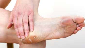 Cracked Heels Treatment: വിണ്ടുകീറിയ പാദങ്ങള്‍ പൂ പോലെ സുന്ദരമാക്കാം, അടുക്കളയിലുണ്ട് പോംവഴി