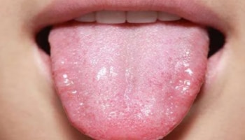 Tongue Burn Remedies : നാക്കിന് പൊള്ളലേറ്റാൽ ചെയ്യേണ്ട കാര്യങ്ങൾ എന്തൊക്കെ?
