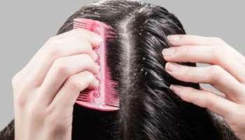 Dandruff remedies: താരനെ തുരത്താൻ വീട്ടിൽ തന്നെയുണ്ട് പരിഹാരങ്ങൾ