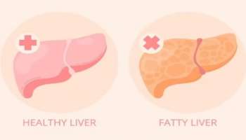 Fatty Liver: ഇന്ത്യയിൽ ഫാറ്റി ലിവർ രോ​ഗികളുടെ എണ്ണം വർധിക്കുന്നു; കരളിന്റെ ആരോ​ഗ്യത്തിൽ ശ്രദ്ധിക്കാം ഇക്കാര്യങ്ങൾ
