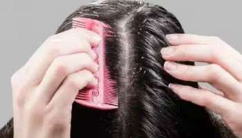 Dandruff: മഴക്കാലത്ത് താരൻ ശല്യം രൂക്ഷമായോ? ഈ അഞ്ച് കാര്യങ്ങൾ മറക്കാതെ ചെയ്യൂ