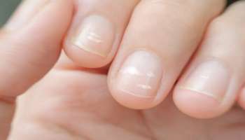 Nail Abnormalities: ഗുരുതര രോ​ഗങ്ങളുടെ ലക്ഷണങ്ങൾ വരെ ന​ഖത്തിലൂടെ അറിയാം; നഖം നൽകുന്ന ഈ സൂചനകൾ അവ​ഗണിക്കരുത്