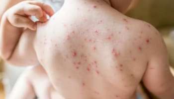 Measles: സംസ്ഥാനത്ത് കുട്ടികള്‍ക്കിടയില്‍ അഞ്ചാംപനി പടരുന്നു; ഒരാഴ്ചക്കിടെ മലപ്പുറത്ത് അഞ്ചാംപനി ബാധിച്ച് രണ്ടു കുട്ടികള്‍ മരിച്ചു