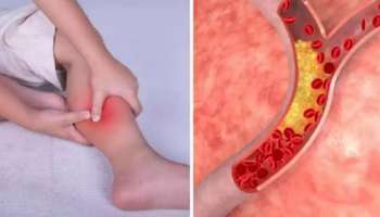 High Cholesterol: ഉയർന്ന കൊളസ്‌ട്രോളിന്റെ ലക്ഷണങ്ങൾ നിങ്ങളുടെ ശരീരം പ്രകടിപ്പിക്കും; അവ​ഗണിക്കരുത് ഈ സൂചനകൾ