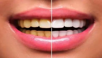 Teeth: പല്ലുകൾ മുത്തുപോലെ തിളങ്ങാൻ വീട്ടിലുള്ള ഈ ഐറ്റംസ് മാത്രം മതി 