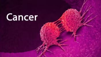 Cancer: സൂക്ഷിക്കൂ....! ഈ ഭക്ഷണങ്ങൾ നിങ്ങളെ ക്യാൻസർ രോ​ഗിയാക്കും