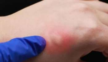 Skeeter syndrome: എന്താണ് സ്കീറ്റർ സിൻഡ്രോം? കൊതുക് കടിയേൽക്കുന്നത് മൂലമുണ്ടാകുന്ന അലർജിയെക്കുറിച്ച് അറിഞ്ഞിരിക്കാം