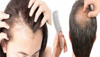 Hairloss Problems: മുടികൊഴിച്ചിലോ..? ഈ പൊടിക്കൈകൾ ഒന്ന് പരീക്ഷിച്ചു നോക്കൂ