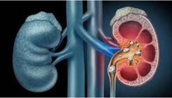 Kidney stone: കിഡ്നി സ്റ്റോൺ ഉള്ളവരുടെ ശ്രദ്ധയ്ക്ക്..! അബദ്ധത്തിൽ പോലും ഈ പച്ചക്കറികൾ കഴിക്കരുത്