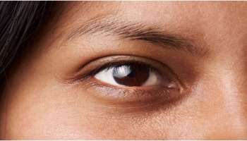 Dark Circles: കണ്ണിന് ചുറ്റുമുള്ള &#039;ഡാർക്ക് സർക്കിൾസ്&#039; ഇല്ലാതാക്കാം: ഈ പൊടിക്കൈകൾ പരീക്ഷിക്കൂ...!