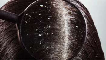 Dandruff: താരൻ അലട്ടുന്നുണ്ടോ? ഈ വീട്ടുവൈദ്യങ്ങളിലുണ്ട് പ്രതിവിധി..!