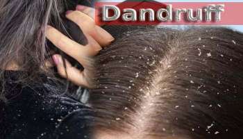 Dandruff: ശൈത്യകാലത്ത് താരന്‍ വര്‍ദ്ധിക്കുന്നുവോ? കാരണമിതാണ്  