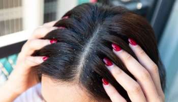 Dandruff in winter: ശൈത്യകാലത്ത് താരൻ വില്ലനാകുന്നോ? ആയുർവേദത്തിലുണ്ട് പരിഹാരം