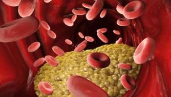 LDL Cholesterol: എൽഡിഎൽ കൊളസ്ട്രോൾ കുറയ്ക്കാം; ഈ ഭക്ഷണങ്ങൾ ഒഴിവാക്കണം
