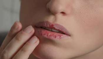 Winter Lips Care: ശൈത്യകാലത്ത് വരണ്ട ചുണ്ടുകളാണോ പ്രശ്‌നം? ഈ വീട്ടുവൈദ്യം പ്രയോഗിക്കൂ