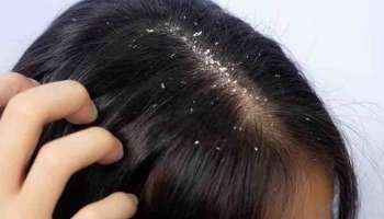 Dandruff Remedies : താരനും മുടി കൊഴിച്ചിലും ചൊറിച്ചിലും അസഹനീയമോ? ഇതാ പ്രതിവധി