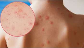 Chickenpox: വേനലില്‍ ചിക്കന്‍പോക്‌സ് പടരാന്‍ സാധ്യത; ലക്ഷണങ്ങള്‍ അറിയാം