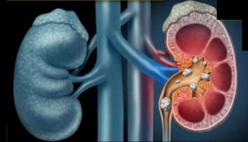 Kidney stone: ഈ 5 ഭക്ഷണങ്ങൾ പതിവാക്കിയാൽ കിഡ്നി അടിച്ചു പോകും ഗയ്സ്!