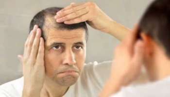 Baldness treatment: കഷണ്ടി എങ്ങനെ ഒഴിവാക്കാം? ഇവ പരീക്ഷിച്ചാൽ കാണാം മാജിക്!