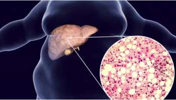 Fatty Liver: ഫാറ്റി ലിവർ ഒഴിവാക്കാൻ കഴിക്കേണ്ടതും കഴിക്കരുതാത്തതും! ഇക്കാര്യങ്ങൾ അറിഞ്ഞിരിക്കണം