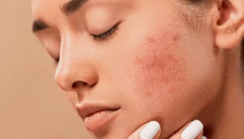 Skin Care: സ്കിൻ അലർജിക്ക് പരിഹാരം, ഇവ കഴിച്ചോളൂ!