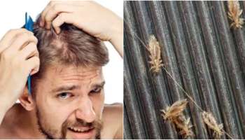 Lice Home Remedies: പേൻ കാരണം തല ചൊറിഞ്ഞ് മടുത്തോ? എങ്കിൽ വീട്ടിലുണ്ട് പരിഹാരം! 