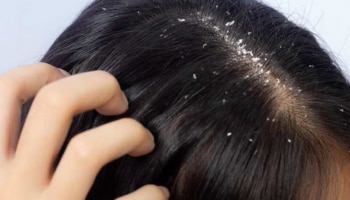  Dandruff: താരനെ അകറ്റാൻ ഇത്ര എളുപ്പമോ! വീട്ടിൽ പരീക്ഷിക്കാവുന്ന ചില പൊടികൈകൾ