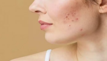 Pimple Marks: മുഖക്കുരുവിന്റെ പാടുകൾ മാറുന്നില്ലേ? ഇനി ടെൻഷൻ വേണ്ട, വീട്ടിൽ തന്നെ പരിഹാരമുണ്ട്