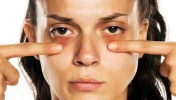 Dark Circles : കണ്ണിന് ചുറ്റമുള്ള കറുപ്പ് എങ്ങനെ മാറ്റാം? ഇതാ ചില പൊടികൈകൾ