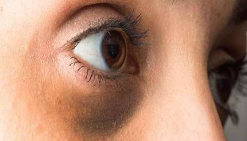 Dark Circles:  കണ്ണിന് ചുറ്റും ഡാര്‍ക്ക് സര്‍ക്കിളുണ്ടോ? എങ്കില്‍ ഇനി പാര്‍ലറില്‍ പോയി സമയം കളയേണ്ട! വീട്ടില്‍ പരീക്ഷിക്കാം ഈ ടിപ്‌സുകള്‍